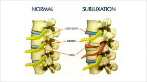 Vertebral Subluxation